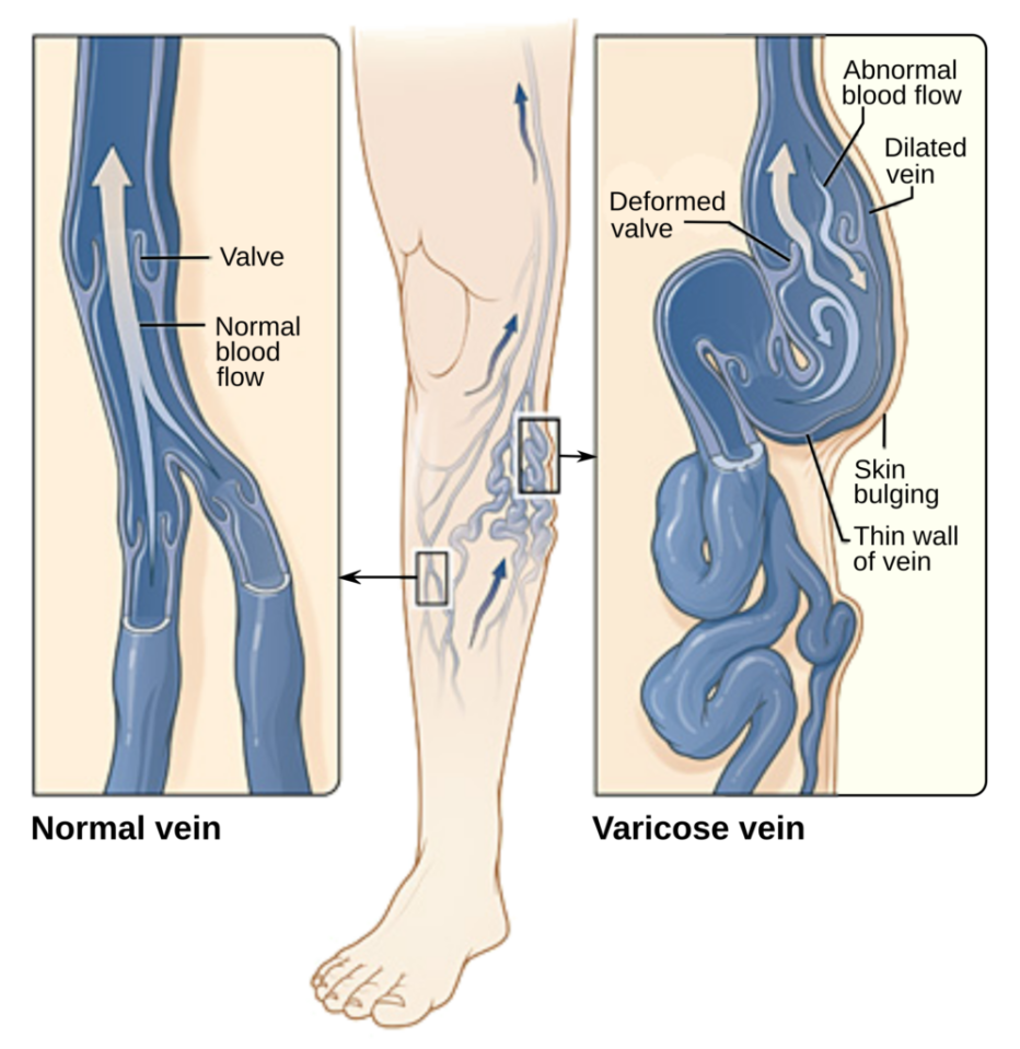 Varicose veins